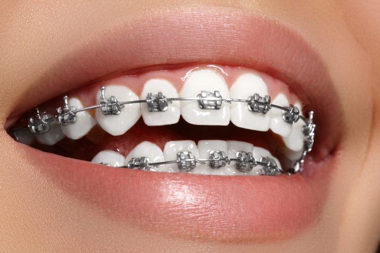 Fixed Artificial Teeth